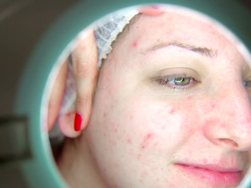 Devojka na pregledu kod dermatologa